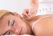 Acupuncture Services