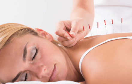 Acupuncture Services